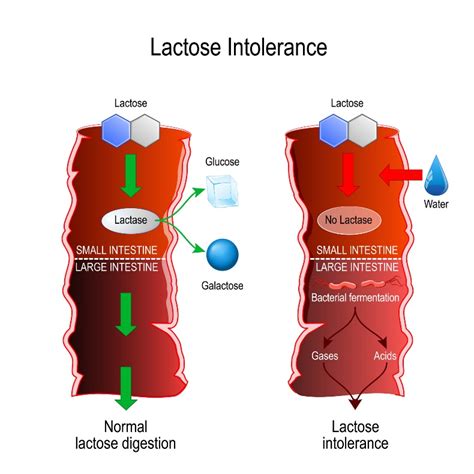 Нарушение пищеварения лактозы