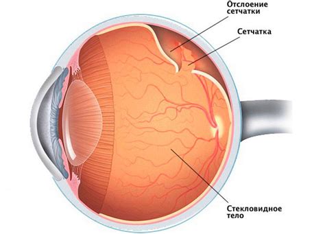 Нарушение работы сетчатки глаза и его последствия