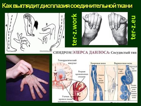 Нарушение соединительной ткани