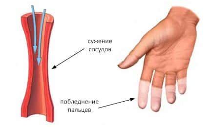 Нарушения в сосудистой системе