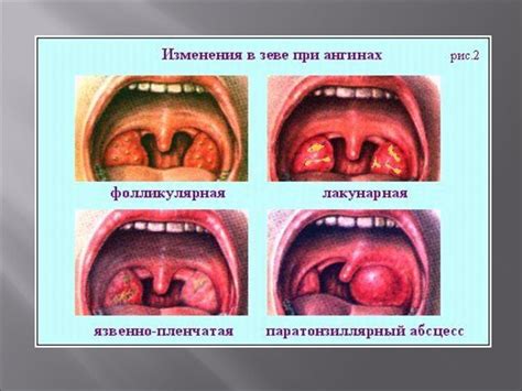 Нарушения в функционировании зева и глотки