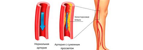 Нарушения кровообращения в ноге