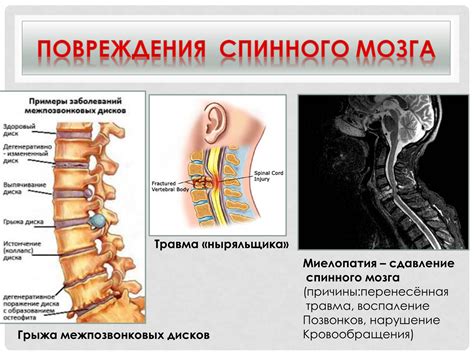 Нарушения позвоночника и спинного мозга