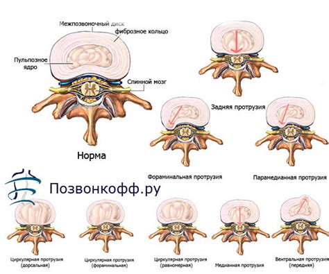 Научные исследования о полезности подтягиваний для протрузии поясничного отдела