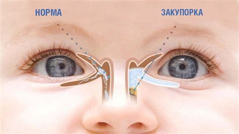 Недоразвитие слезных протоков