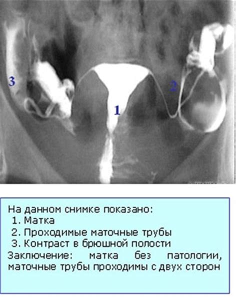 Необходимость проведения ГСГ