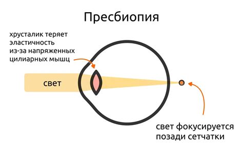 Неправильная рефракция глаза