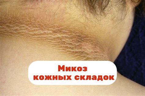 Неправильное лечение микоза