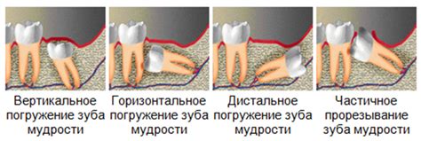 Неправильное погружение корней