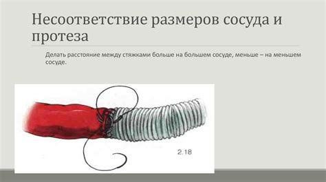 Несоответствие размеров протеза