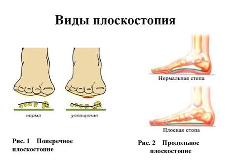 Неустойчивая плоскостопие