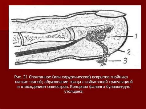 Образование гнойника с наличием пузыря