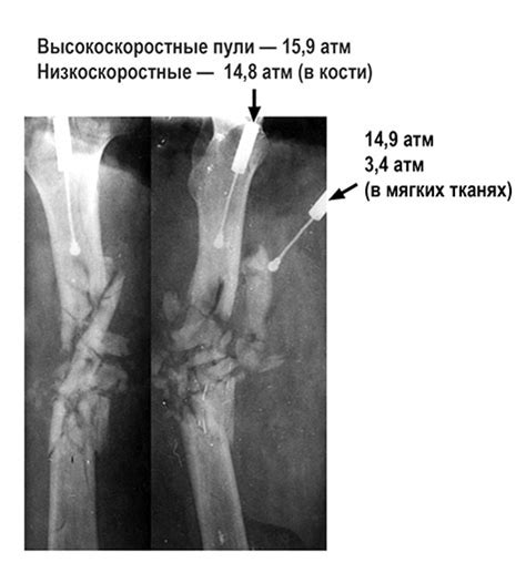 Образование гнойных осложнений