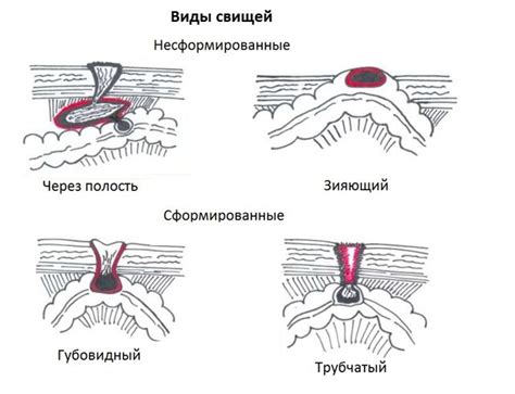 Образование рубца на месте шва