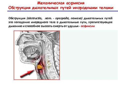 Обструкция дыхательных путей