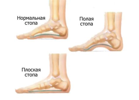 Одна тапочка и проблемы стопы