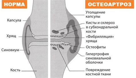 Ожирение и его связь с воспалением суставов