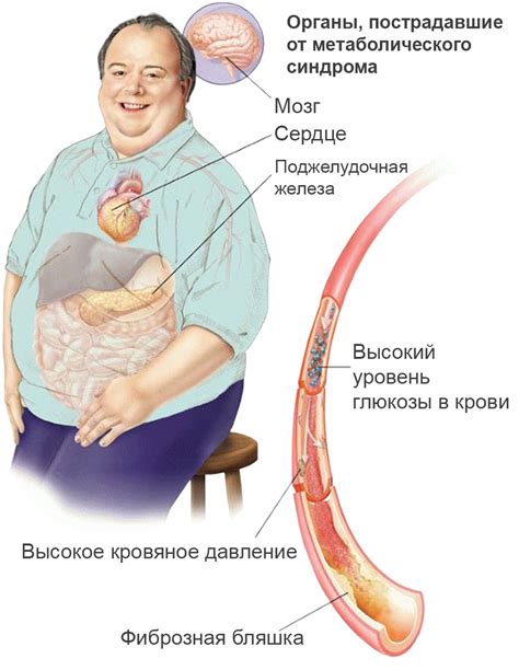 Ожирение и метаболический синдром