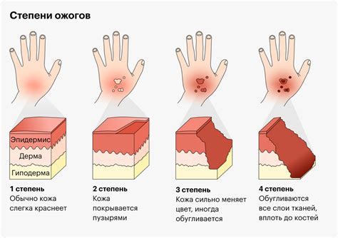 Ожоги и раздражение кожи