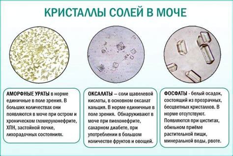 Оксалаты в моче у ребенка: причины и возникновение