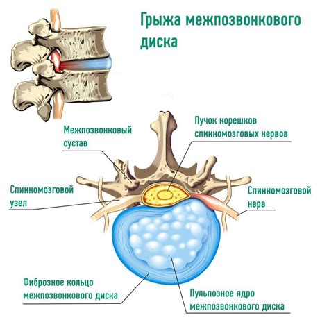 Опасности для межпозвонковых дисков