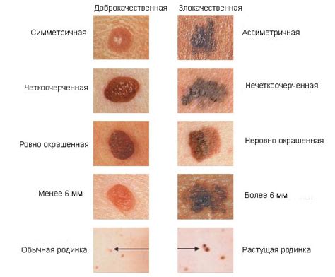 Опасности и последствия поцарапывания родинки