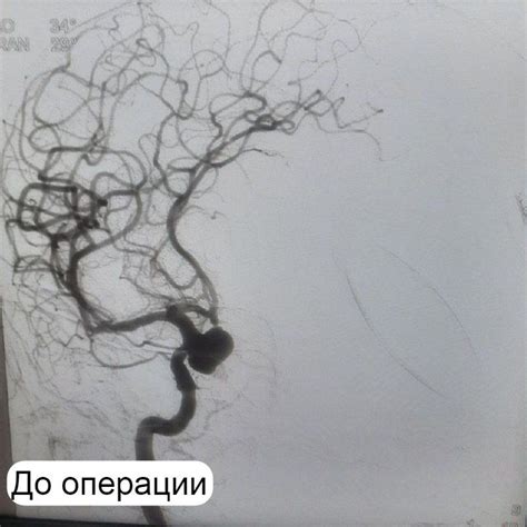 Оперативное лечение аневризмы головного мозга