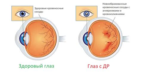 Операция катаракты при дистрофии сетчатки: что это такое