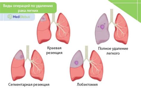 Операция при раке легких с метастазами: основная информация