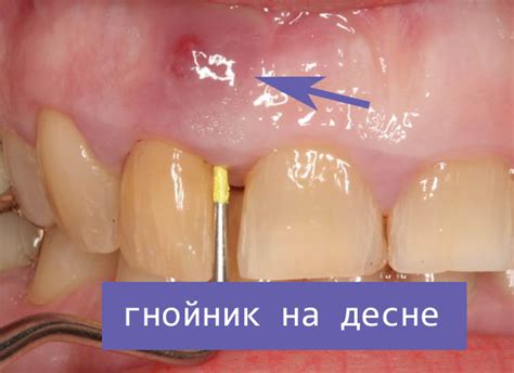 Определение гнойника на десне