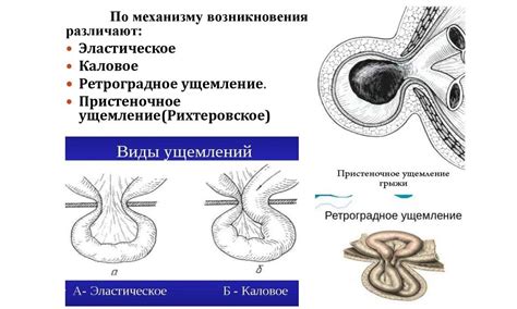 Определение и причины грыжи