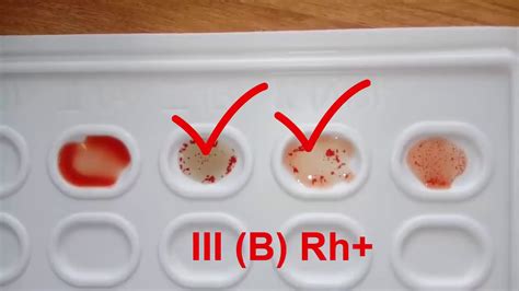 Определение кровеносной группы и резус-фактора