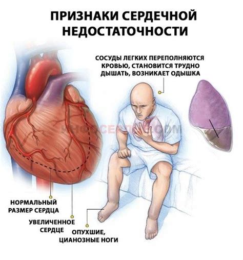 Определение сердечной недостаточности