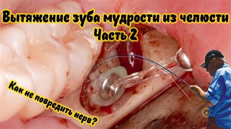 Осложнение после удаления нерва