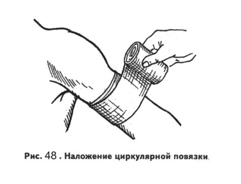 Осложнения от неправильного накладывания жгута