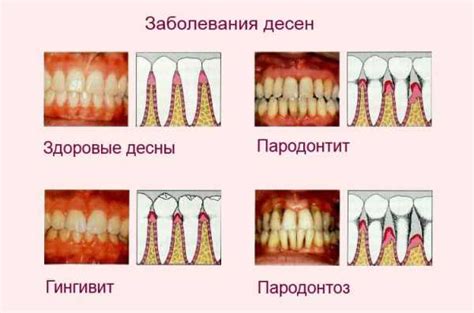 Основные методы лечения воспаления десен при простуде