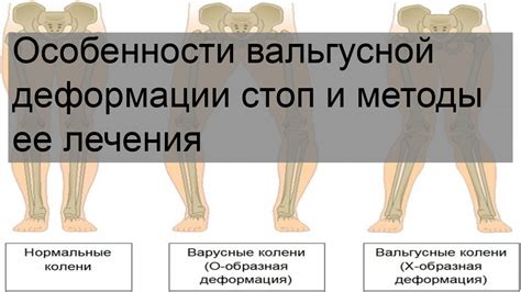 Основные методы профилактики вальгусной деформации