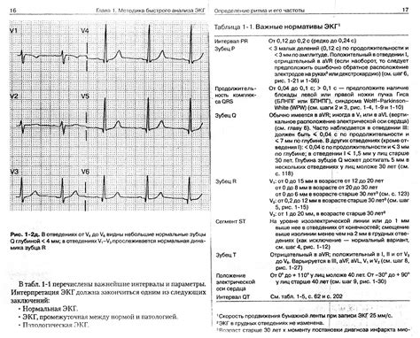 Основные отклонения ЭКГ