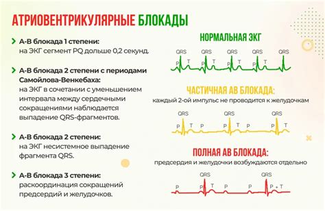 Основные признаки КШС на ЭКГ