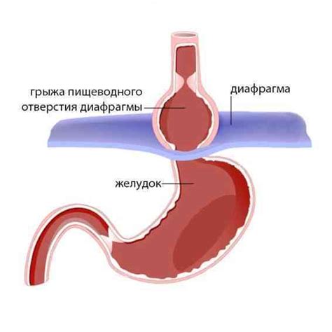 Основные признаки грыжи пищевода