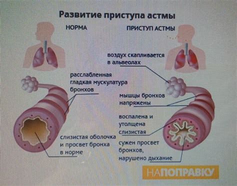 Основные принципы лечения мокроты бронхиальной астмы