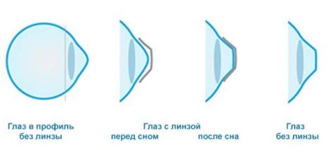 Основные принципы ношения линз для коррекции зрения