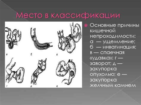 Основные причины непроходимости нефростомы