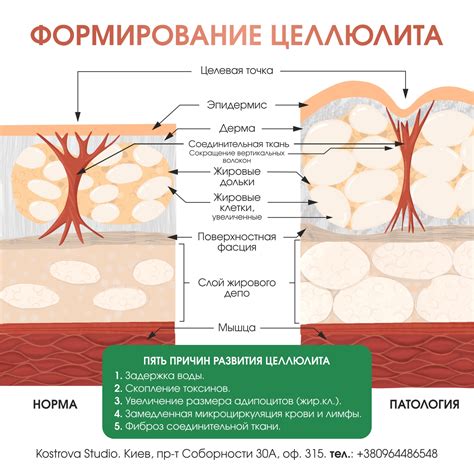 Основные причины образования ушек и целлюлита