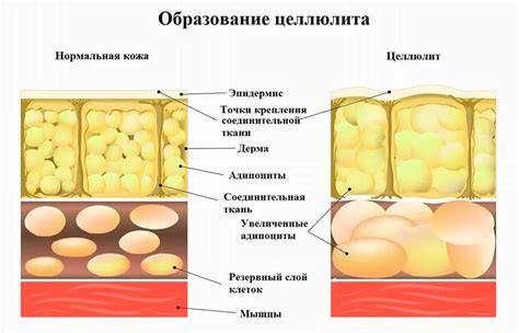 Основные причины появления целлюлита на ногах