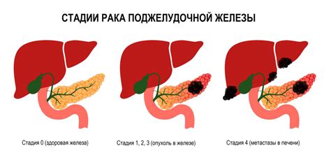 Основные симптомы нарушений в работе поджелудочной железы