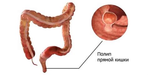 Основные симптомы полипа в прямой кишке