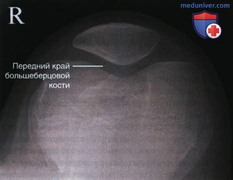 Основные составляющие бедренного сустава