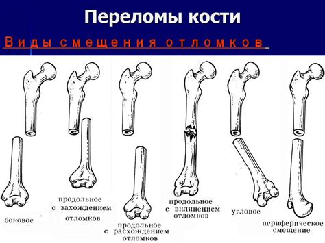 Основные типы переломов руки