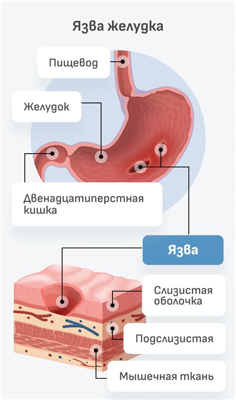 Особенности выбора роллов при язве желудка и 12-перстной кишки